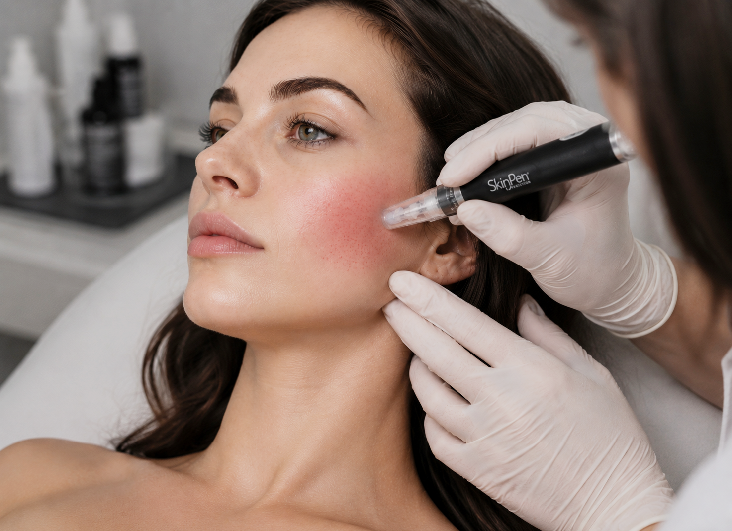 SkinPen® Microneedling